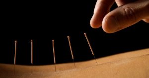 acupuncture2