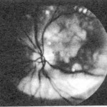 p159fundus1