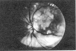 p159fundus1