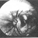 p159fundus2